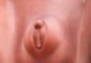 Sexo fetal na Ultrassonografia